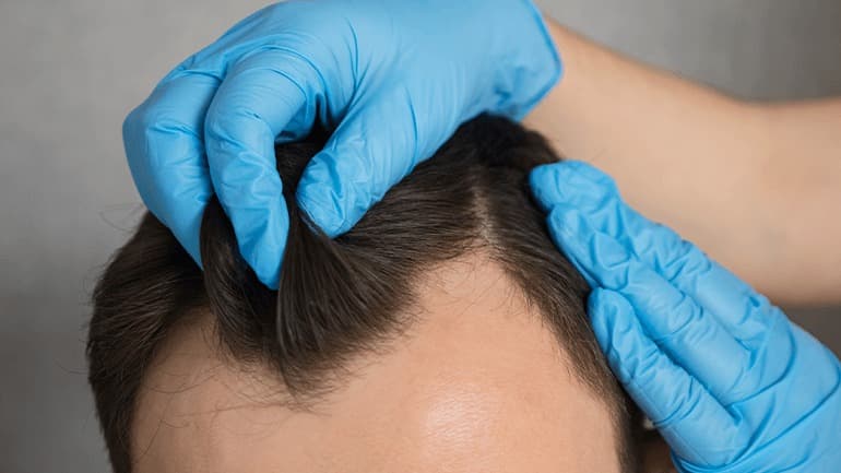 Hair Transplant Turkey at Sapphire Hair Clinic – Book Now
