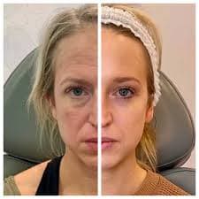 HarmonyCA Treatment for Collagen Stimulation