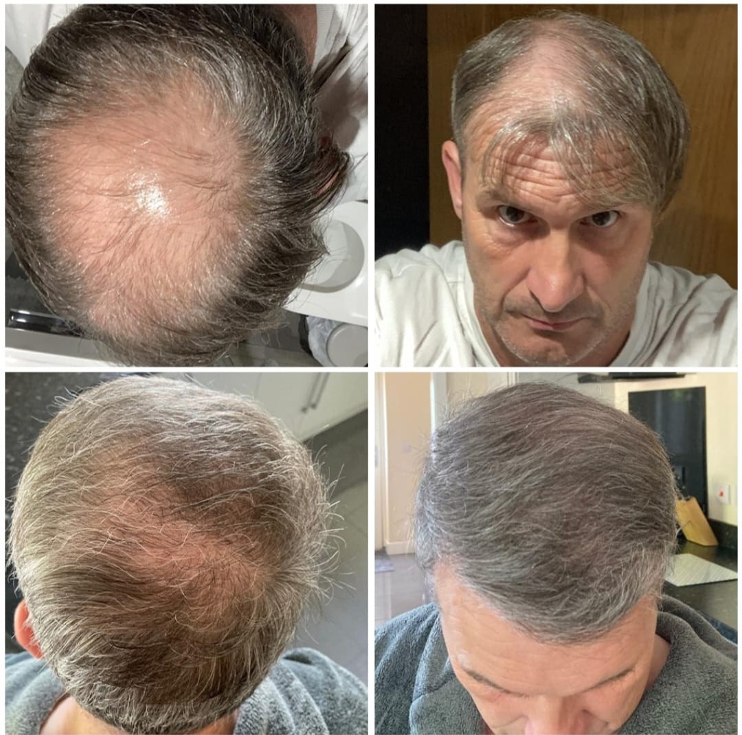 Hair Transplant London Reviews – Why Patients Recommend Us