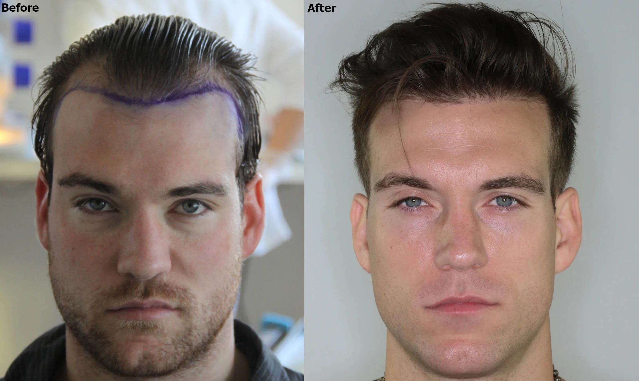 Hair Transplant London by Top Surgeons – Achieve Natural Hair Growth