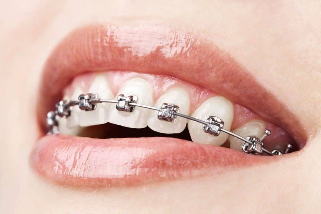 Comprehensive Guide to Level Orthodontics: Techniques, Benefits, and Patient Care